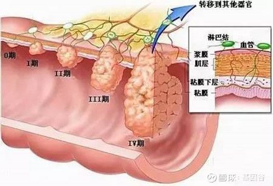 基因检测有助于结直肠癌的筛查工作(图4)